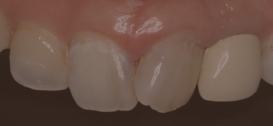 歯の画像